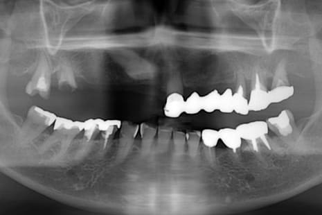 抜歯即時による上顎オールオン４術前レントゲン