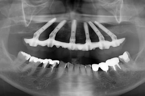 抜歯即時による上顎オールオン４術後レントゲン