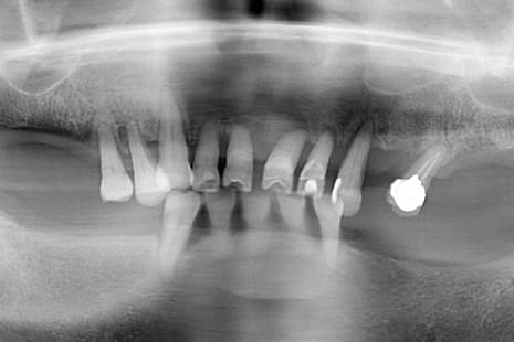 フラップレス術式の上顎オールオン４ 術前レントゲン