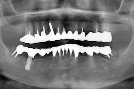 下顎のオールオン４ 術前レントゲン