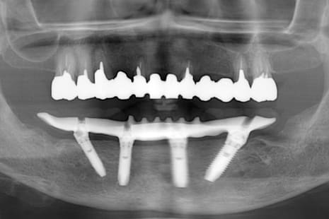 下顎のオールオン４ 術後レントゲン