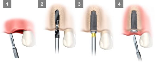 一般的な2回法インプラント手術