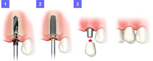 メスを使わない無切開フラップレス手術